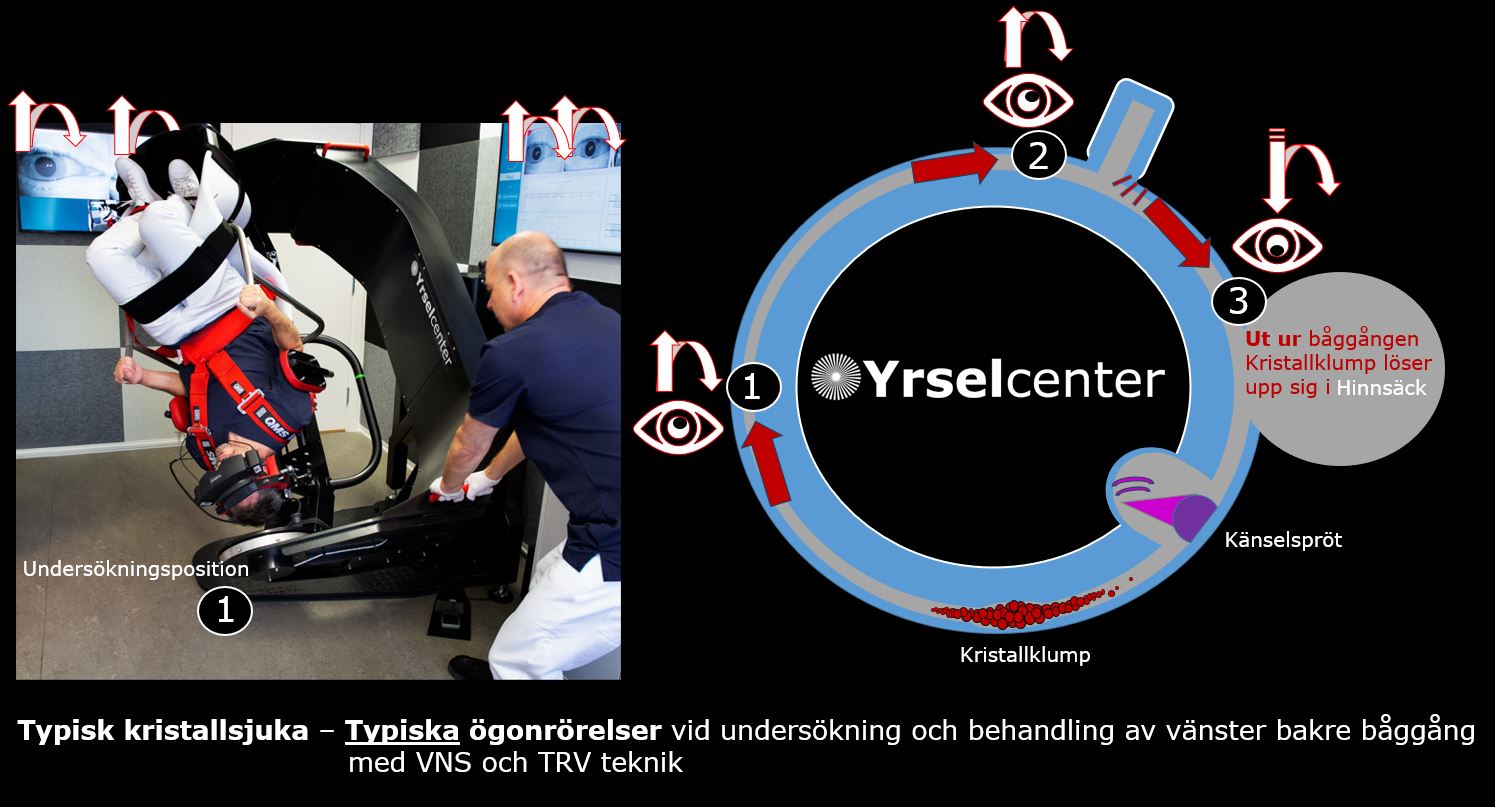 Atypisk lägesyrsel - lägesyrsel som inte är typisk för kristallsjuka