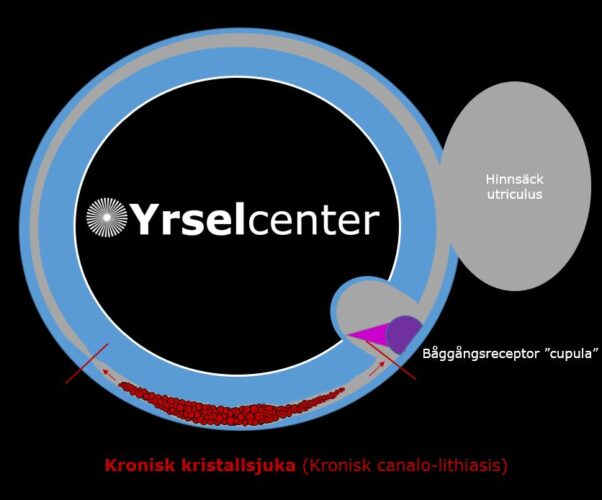 Kronisk kristallsjuka