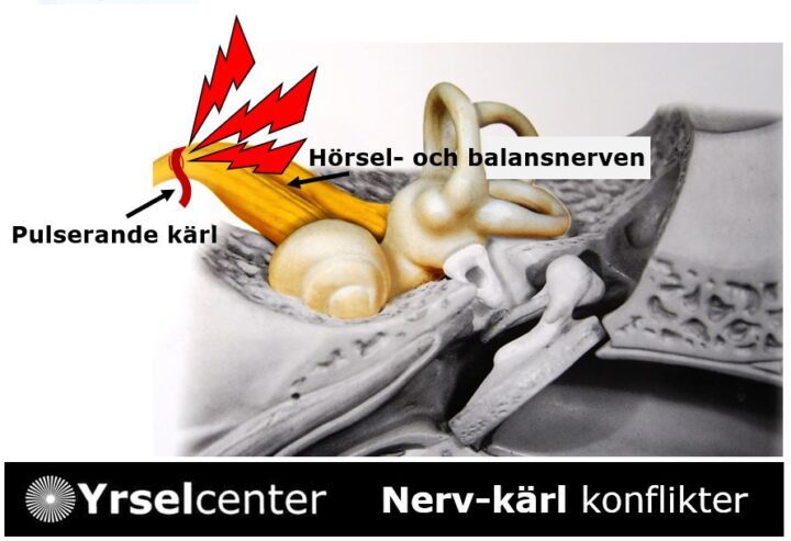 Nerv-kärl-konflikt som ger yrselanfall