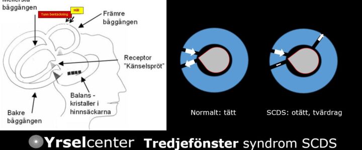 Takfönstersyndrom Tredje fönster syndrom Yrselcenter