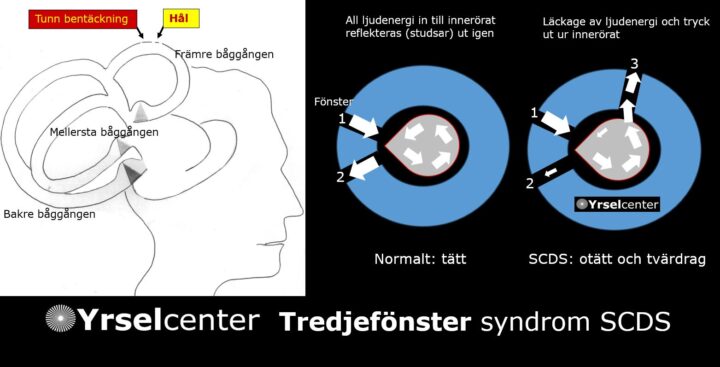 Takfönstersyndrom SuperiorCanalDehiscenceSyndrome SCDS