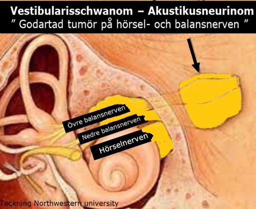 Godartad tumör på hörsel- och balansnerven
